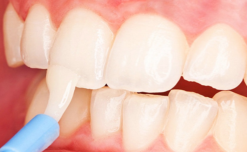 Điều trị răng sâu nhẹ bằng kỹ thuật tái khoáng men răng