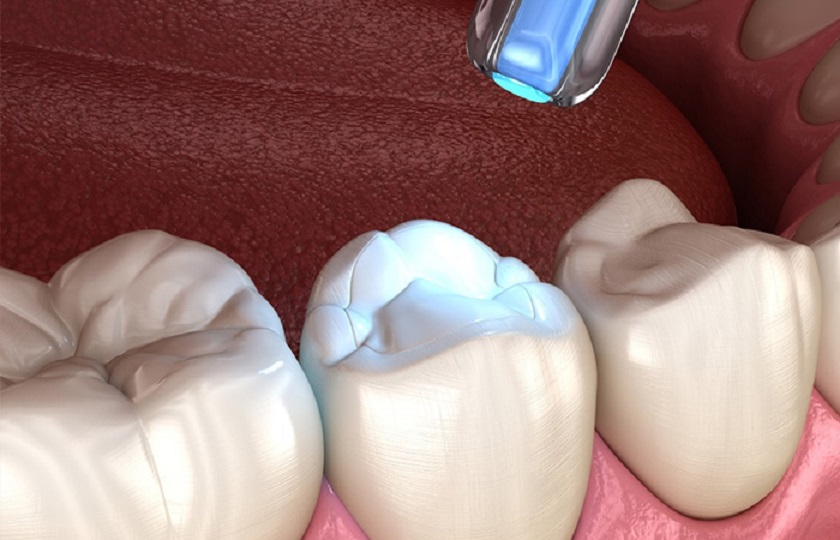 Điều trị răng sâu nhẹ bằng kỹ thuật trám răng