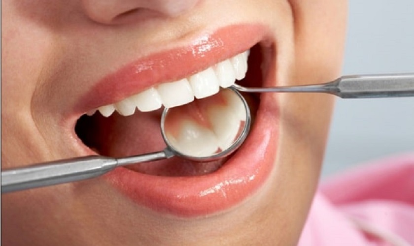 Răng sâu nhẹ điều trị thế nào hiệu quả nhất?