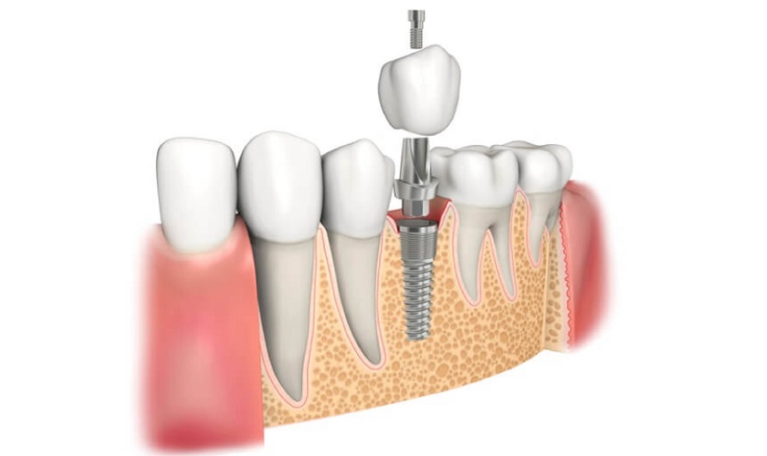 Kỹ thuật phục hình răng bằng cấy ghép Implant