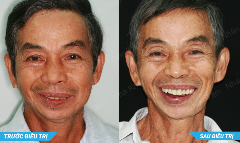Hình ảnh ông Nguyễn Văn Lượm trước và sau điều trị tại Nha khoa Nhân Tâm