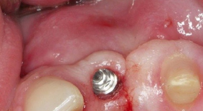 Sưng viêm sau khi cấy ghép răng Implant