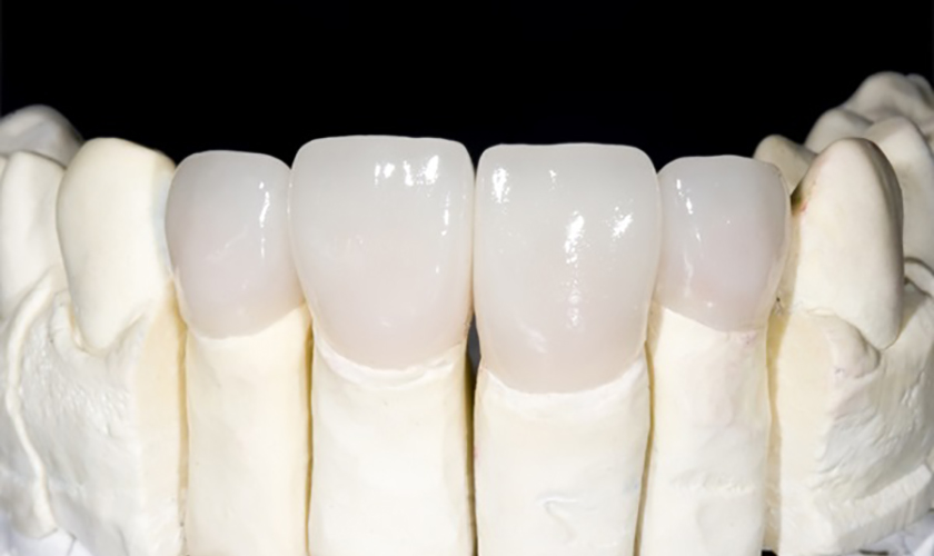 Răng tạm trên Implant