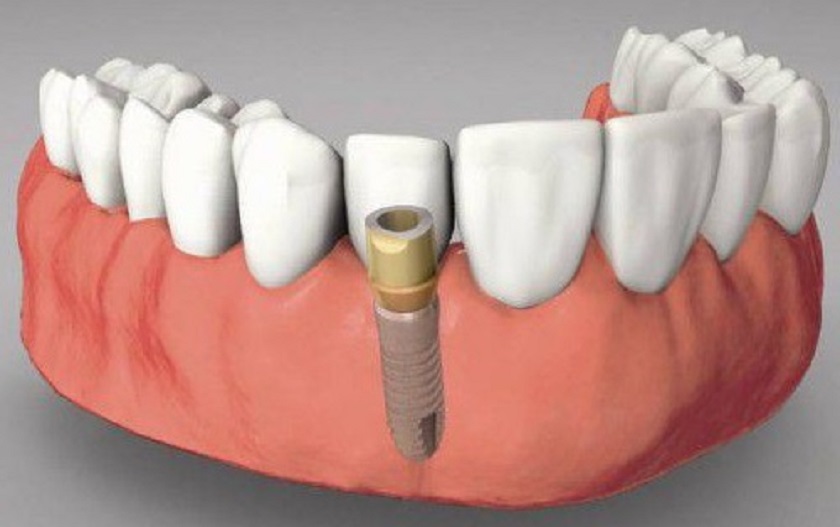Nên sử dụng răng tạm trên Implant trong thời gian bao lâu?