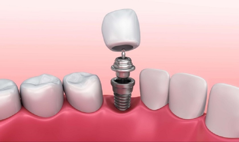Thời gian và trường hợp nên gắn răng tạm sau khi trồng răng Implant