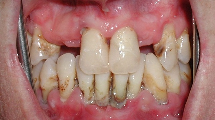 Người đang mắc bệnh răng miệng không thể ghép xương nhân tạo