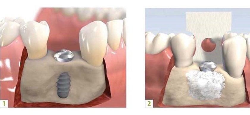 Kỹ thuật ghép xương trong Implant nha khoa giúp bù đắp phần xương hàm bị thiếu