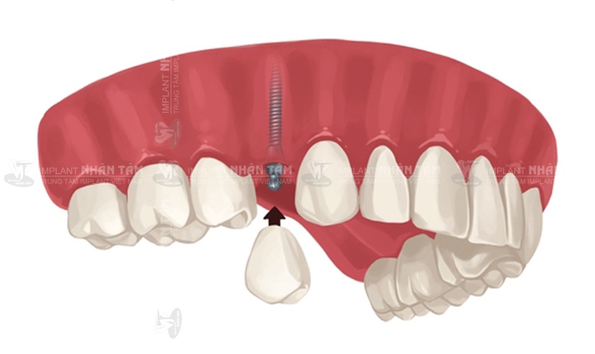 Giá cấy răng Implant lẻ được tính dựa trên bộ phận cấu thành nên nó