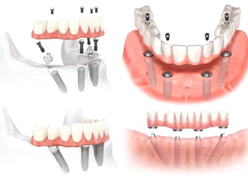 Phương pháp cấy ghép Implant All on 4 với 4 chân răng giả được sử dụng