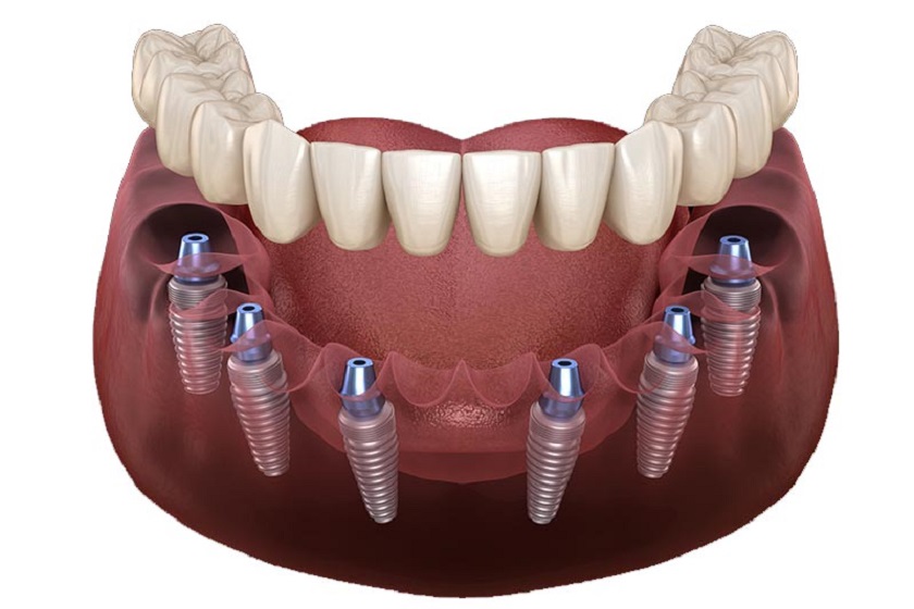 Cấy ghép Implant All on 6 sử dụng 6 trụ Implant để nâng đỡ hàm giả phục hình thân răng