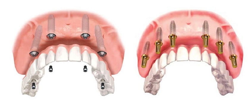 Giá làm răng Implant nguyên hàm hiện nay là bao nhiêu?