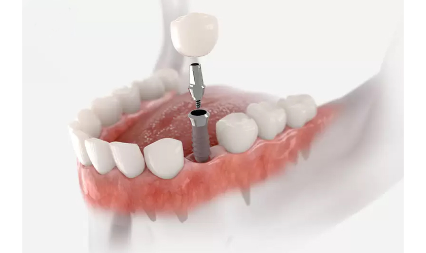 Hình ảnh mô phỏng phương pháp phục hình răng bằng cấy ghép Implant