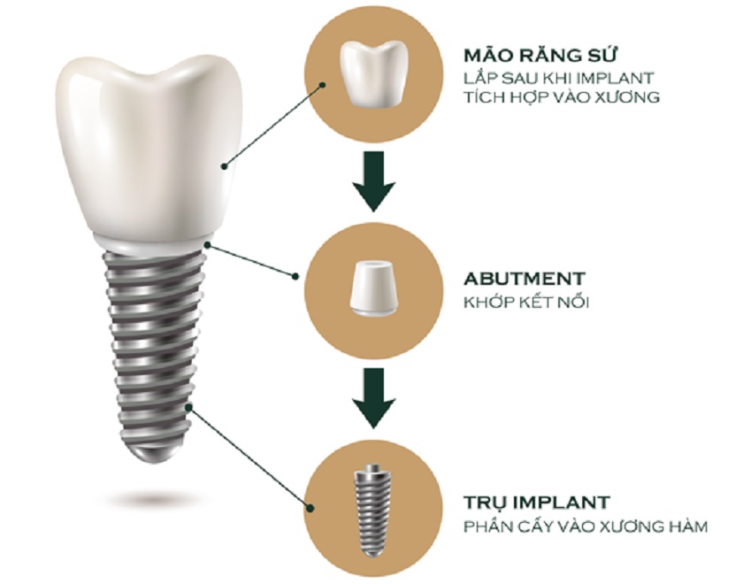 Giá trồng răng Implant đơn lẻ bao gồm cả giá thành của trụ Implant, Abutment, răng sứ