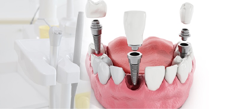 Trồng răng Implant đơn lẻ phục hình các răng mất không liền kề