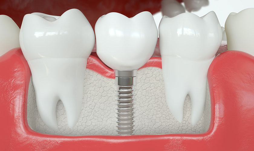 Chi phí cấy ghép răng Implant đơn lẻ là bao nhiêu?