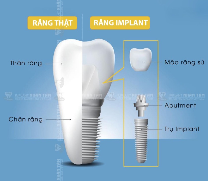 Giá trồng răng Implant trọn gói
