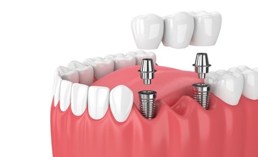Làm cầu răng sứ trên Implant khi mất nhiều răng liền kề