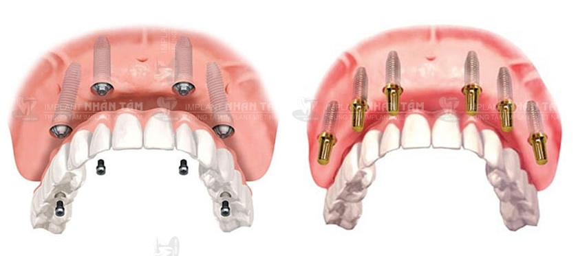 Trồng răng Implant All on 4/ All on 6 giúp bạn tiết kiệm được nhiều chi phí