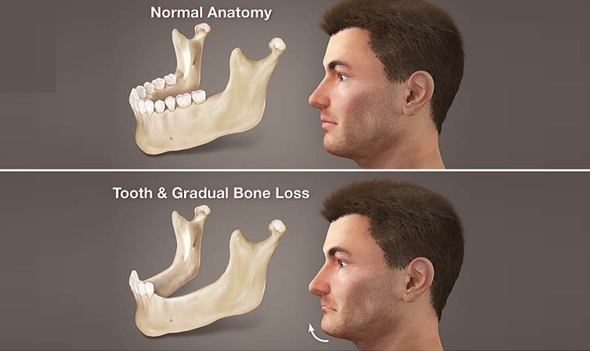 Răng giả tháo lắp không ngăn chặn được quá trình tiêu xương hàm