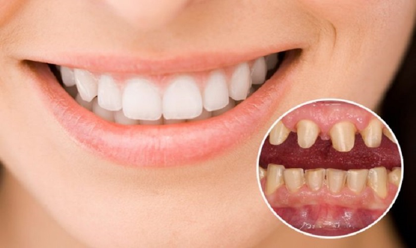 Bọc răng sứ giúp bảo vệ răng thật khỏi các tác động từ môi trường ngoài