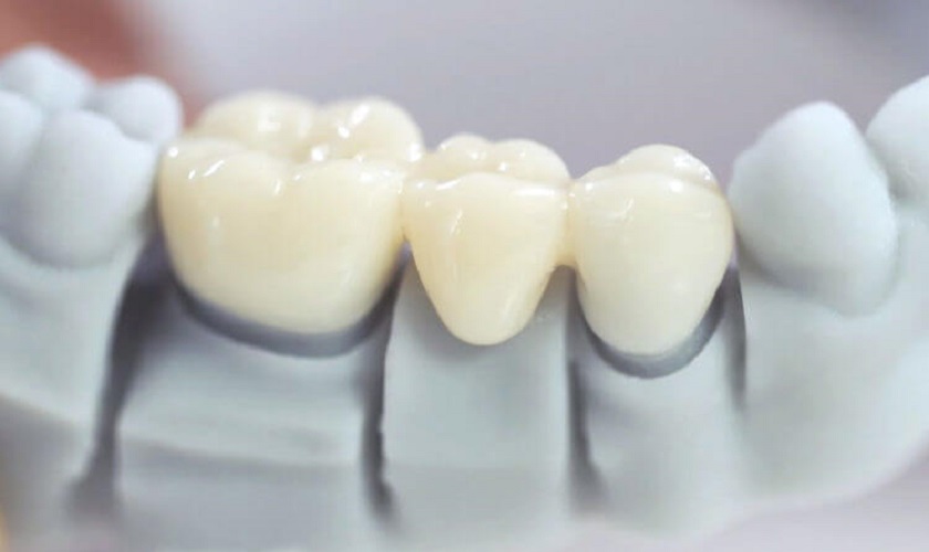 Vì sao lại xuất hiện những loại răng sứ giá rẻ trên thị trường?
