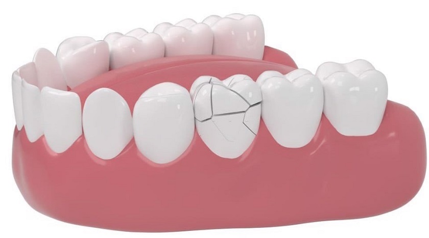 Răng sứ giá rẻ, kém chất lượng rất dễ bị hỏng sau một thời gian ngắn
