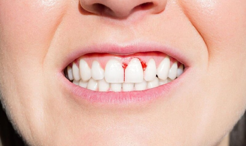 Viêm lợi do bọc răng sứ kém chất lượng