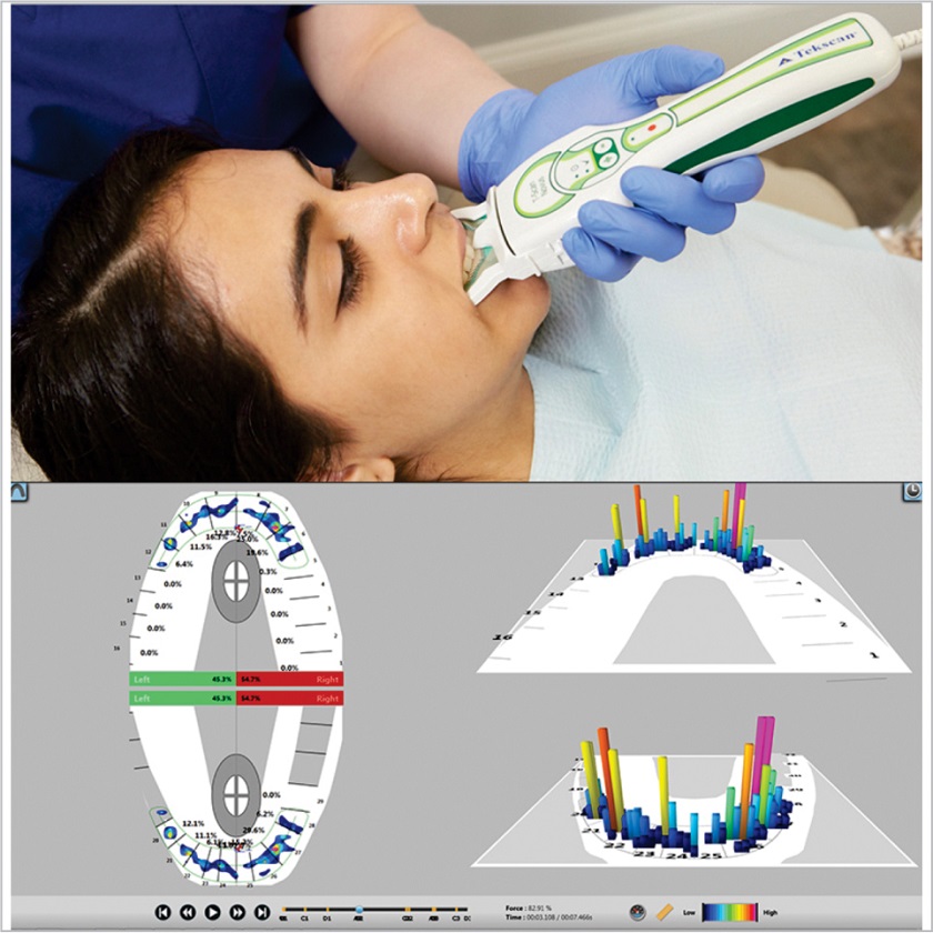 Ứng dụng hệ thống thẩm định – phân tích khớp cắn T-Scan trong điều trị có tiến hành phục hình răng
