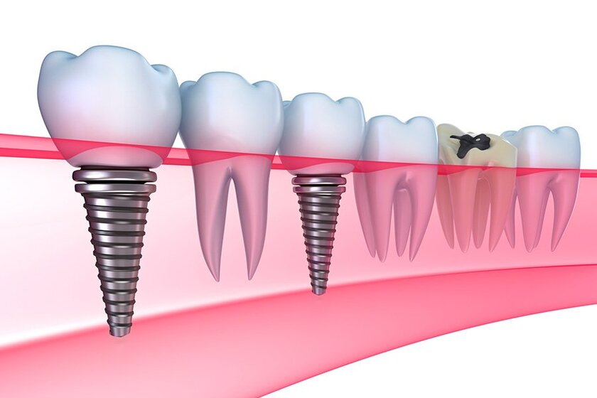 Trồng răng implant hiện nay là phương pháp trồng răng hoàn thiện