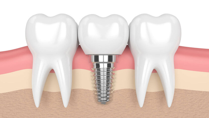Trồng răng implant là kỹ thuật không làm ảnh hưởng đến các răng bên cạnh