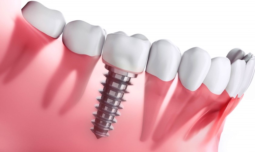 Phục hình răng tạm trên Implant