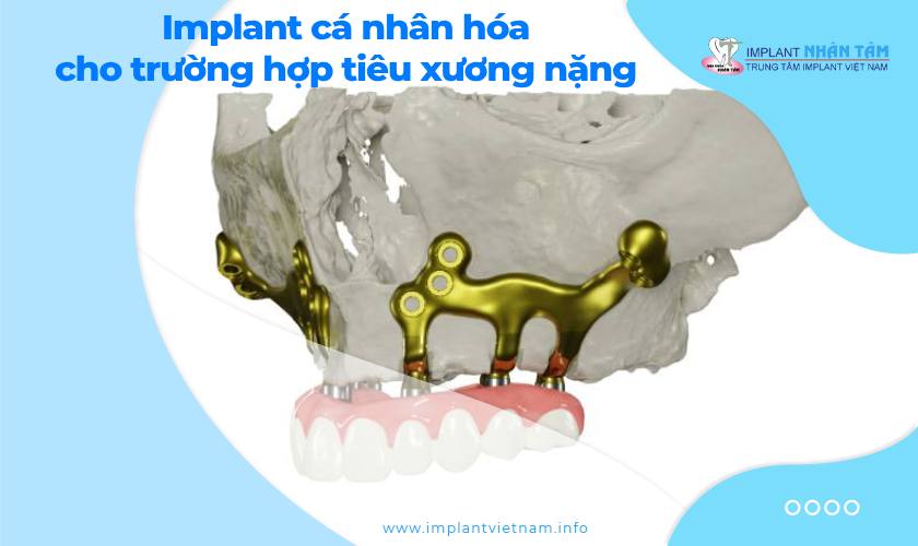Implant cá nhân hóa giải pháp cho trường hợp tiêu xương nặng Implant cá nhân hóa giải pháp cho trường hợp tiêu xương nặng