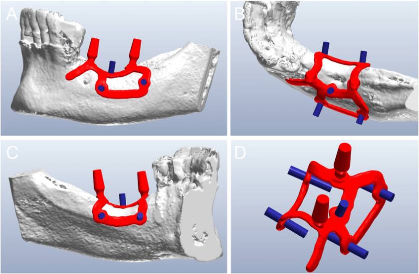 Implant cá nhân hóa mang lại tỷ lệ thành công lên đến hơn 95%, ngay cả với những trường hợp phức tạp mà kỹ thuật Implant thông thường không thể thực hiện Implant cá nhân hóa mang lại tỷ lệ thành công lên đến hơn 95%, ngay cả với những trường hợp phức tạp mà kỹ thuật Implant thông thường không thể thực hiện