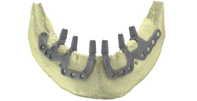 Quy trình thực hiện Implant cá nhân hóa được thiết kế để hạn chế tối đa việc can thiệp vào cấu trúc xương hàm và mô nướu Quy trình thực hiện Implant cá nhân hóa được thiết kế để hạn chế tối đa việc can thiệp vào cấu trúc xương hàm và mô nướu