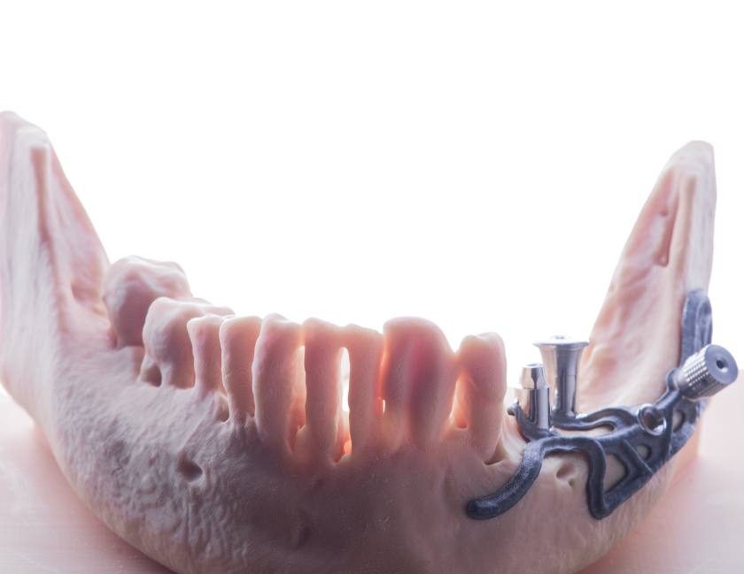 Cấy ghép Implant cá nhân hóa phù hợp với những trường hợp không đủ điều kiện ghép xương Cấy ghép Implant cá nhân hóa phù hợp với những trường hợp không đủ điều kiện ghép xương