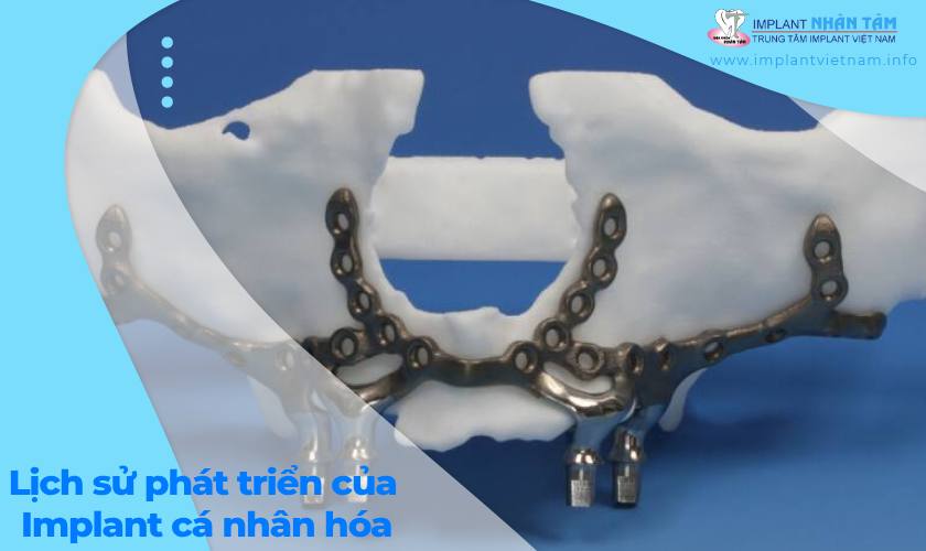 Lịch sử phát triển của Implant cá nhân hóa Lịch sử phát triển của Implant cá nhân hóa