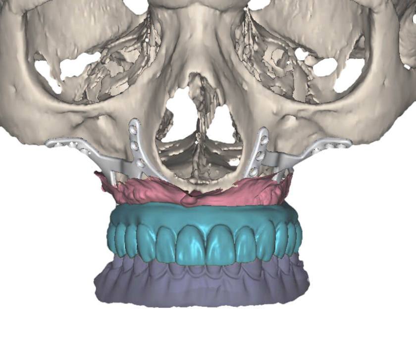 Sự phát triển của công nghệ in 3D đã mở ra một kỷ nguyên mới cho kỹ thuật Implant dưới màng xương Sự phát triển của công nghệ in 3D đã mở ra một kỷ nguyên mới cho kỹ thuật Implant dưới màng xương