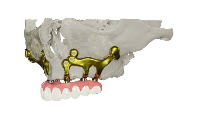 Implant cá nhân hóa kế thừa nền tảng của kỹ thuật Implant dưới màng xương Implant cá nhân hóa kế thừa nền tảng của kỹ thuật Implant dưới màng xương