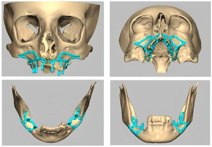 Implant cá nhân hóa phù hợp với các trường hợp giải phẫu xương hàm phức tạp Implant cá nhân hóa phù hợp với các trường hợp giải phẫu xương hàm phức tạp