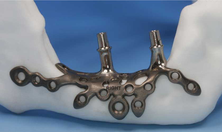 Với phương pháp cấy ghép Implant cá nhân hóa, Bác sĩ sẽ sử dụng một bộ cấy ghép Implant được thiết kế riêng biệt theo giải phẫu xương hàm của Khách hàng Với phương pháp cấy ghép Implant cá nhân hóa, Bác sĩ sẽ sử dụng một bộ cấy ghép Implant được thiết kế riêng biệt theo giải phẫu xương hàm của Khách hàng
