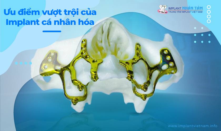 Ưu điểm vượt trội của implant cá nhân hóa Ưu điểm vượt trội của implant cá nhân hóa