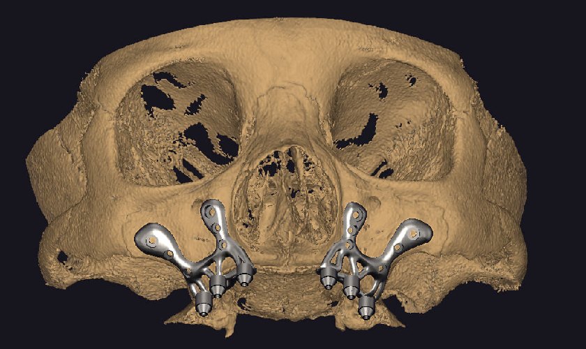 Cấy ghép Implant cá nhân hóa không bị ảnh hưởng bởi chất lượng xương hàm Cấy ghép Implant cá nhân hóa không bị ảnh hưởng bởi chất lượng xương hàm