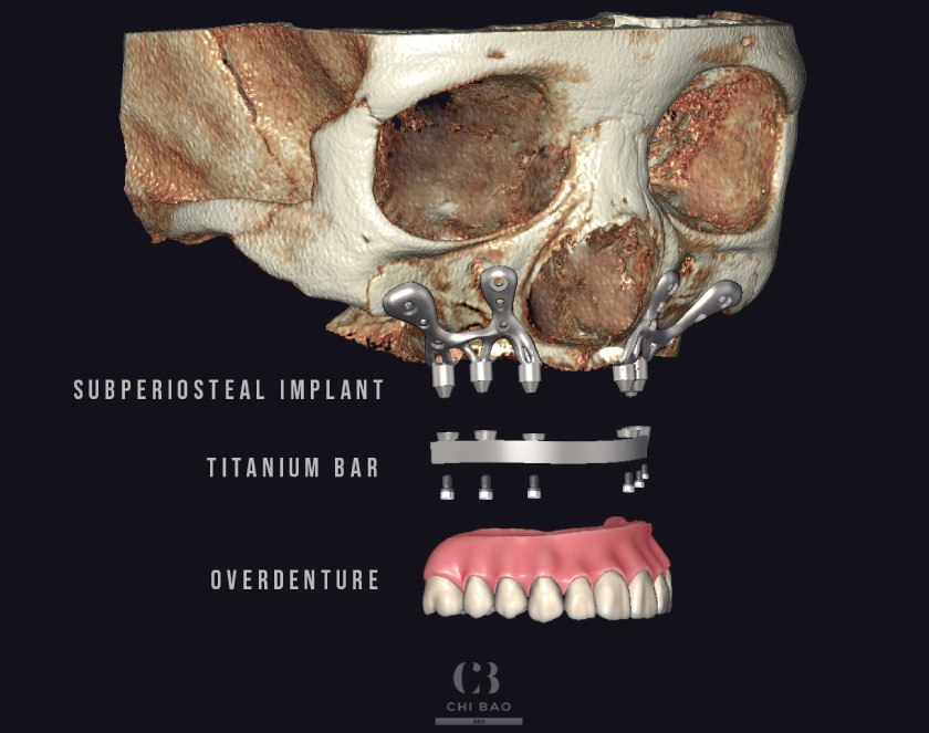 Kỹ thuật Implant cá nhân hóa giúp duy trì sự ổn định của xương hàm, ngăn ngừa tiêu xương hiệu quả Kỹ thuật Implant cá nhân hóa giúp duy trì sự ổn định của xương hàm, ngăn ngừa tiêu xương hiệu quả