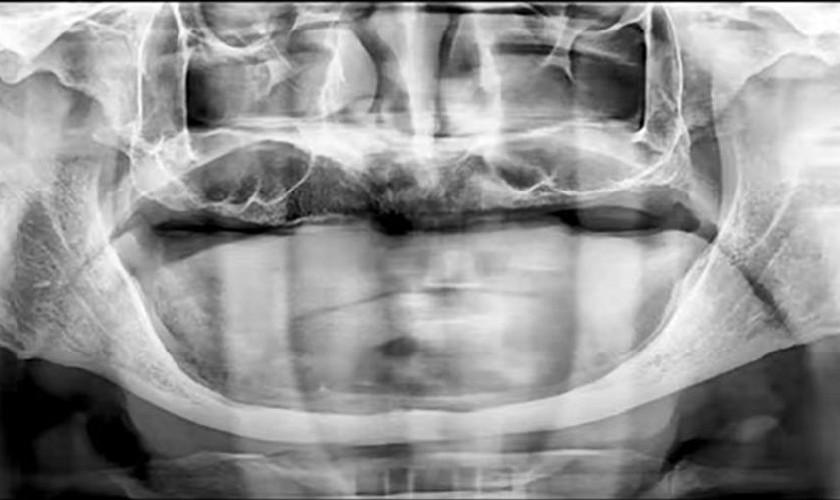 Khách hàng không răng bẩm sinh đến với trung tâm Implant Việt Nam trong tình trạng xương hàm vô cùng phức tạp, chỉ còn chưa đến 2mm Khách hàng không răng bẩm sinh đến với trung tâm Implant Việt Nam trong tình trạng xương hàm vô cùng phức tạp, chỉ còn chưa đến 2mm