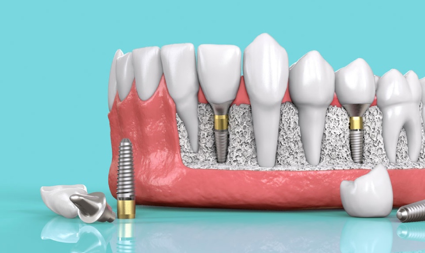 10 lợi ích của việc cấy răng implant