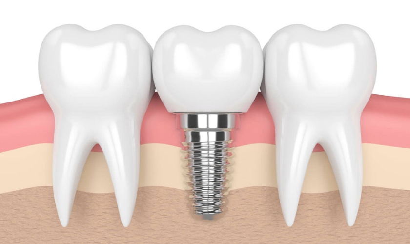 Răng implant được cố định chặt chẽ
