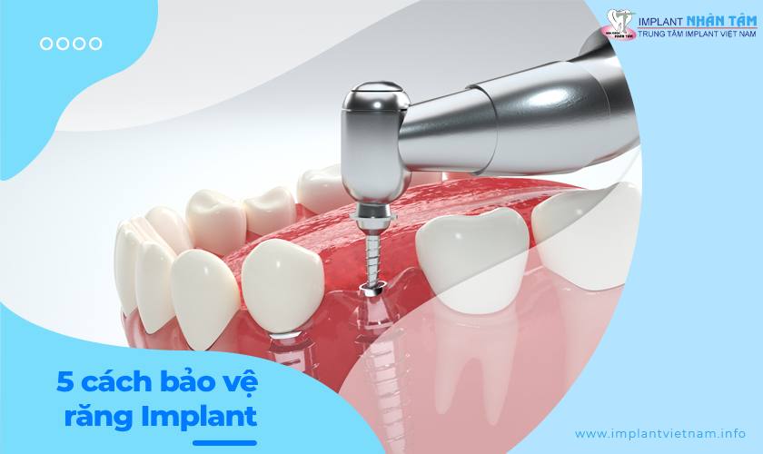 5 cách bảo vệ trụ Implant bền lâu sau phẫu thuật thành công 5 cách bảo vệ trụ Implant bền lâu sau phẫu thuật thành công