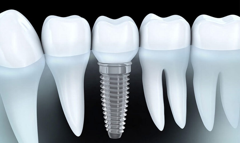 Răng Implant là giải pháp điều trị mất răng tối ưu nhất hiện nay, phục hồi ăn nhai và thẩm mỹ như răng thật Răng Implant là giải pháp điều trị mất răng tối ưu nhất hiện nay, phục hồi ăn nhai và thẩm mỹ như răng thật