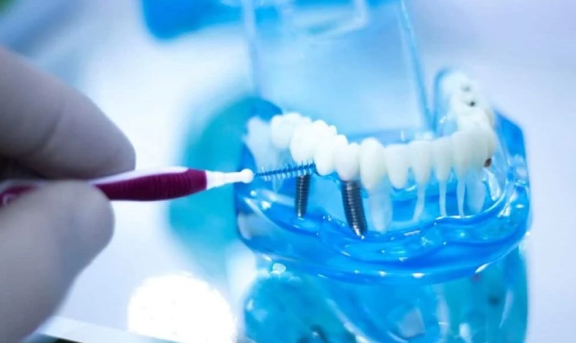 Cần chăm sóc răng miệng kỹ lưỡng sau khi cấy Implant