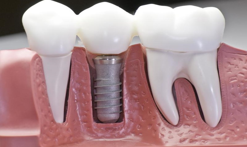 Cấy ghép Implant Nobel Active Mỹ phục hồi nhanh răng đã mất.